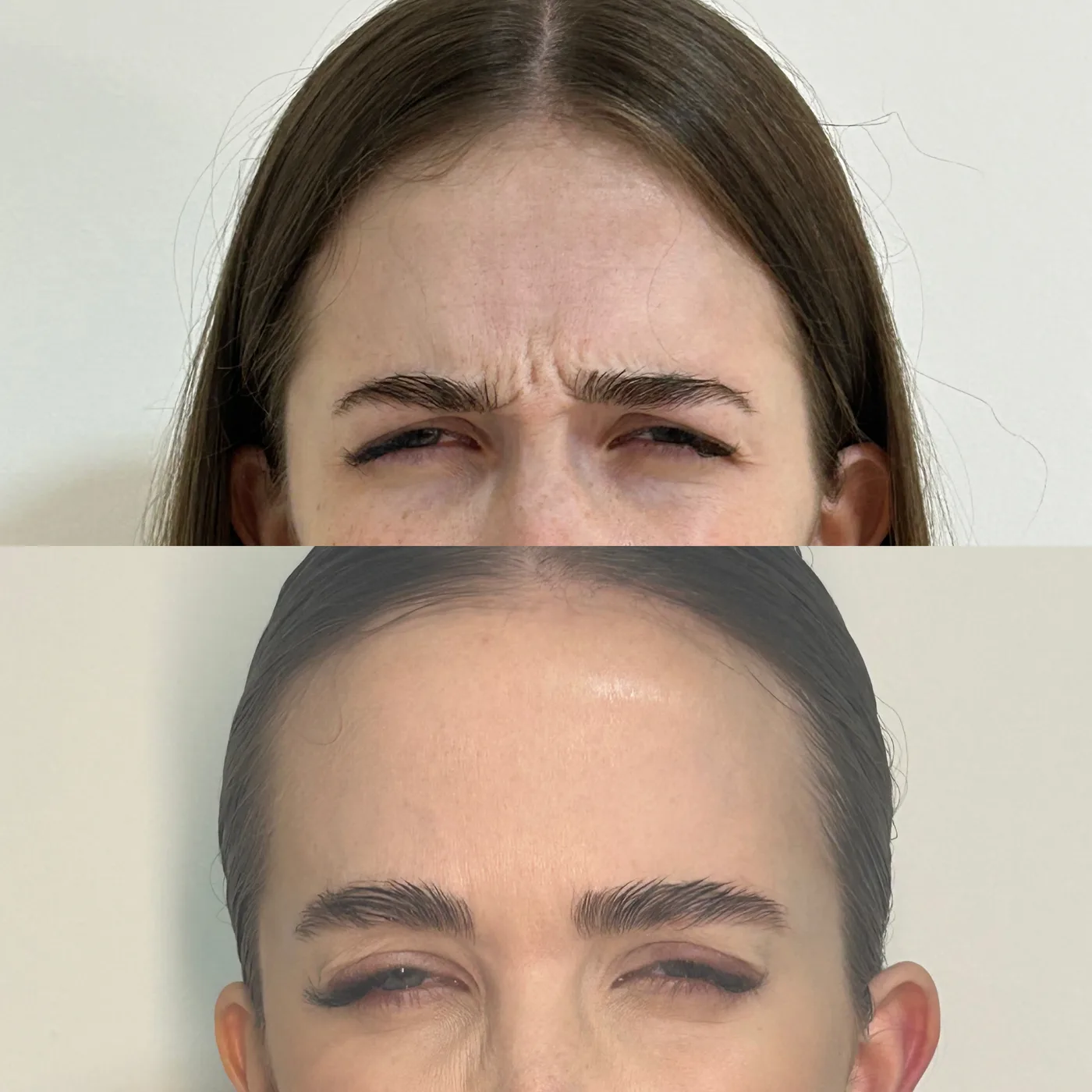 Antes e depois de suavização das linhas entre as sobrancelhas