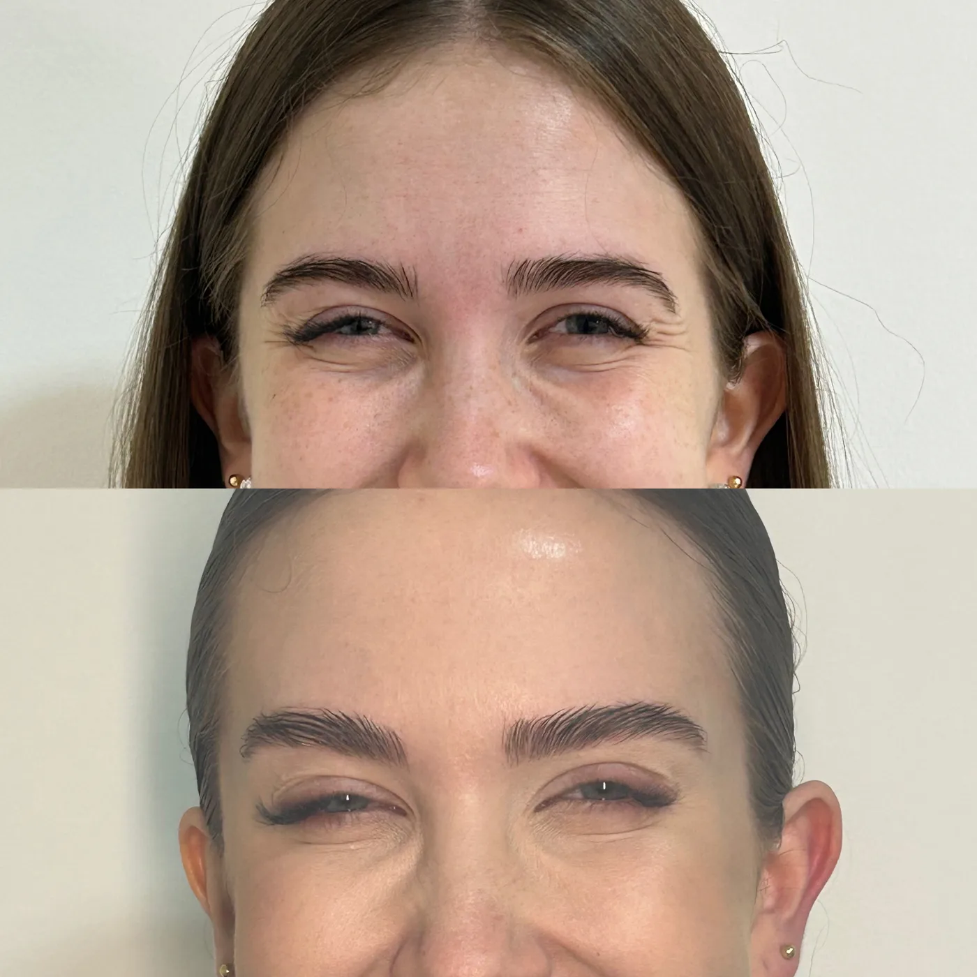 Antes e depois de suavização dos pés de galinha