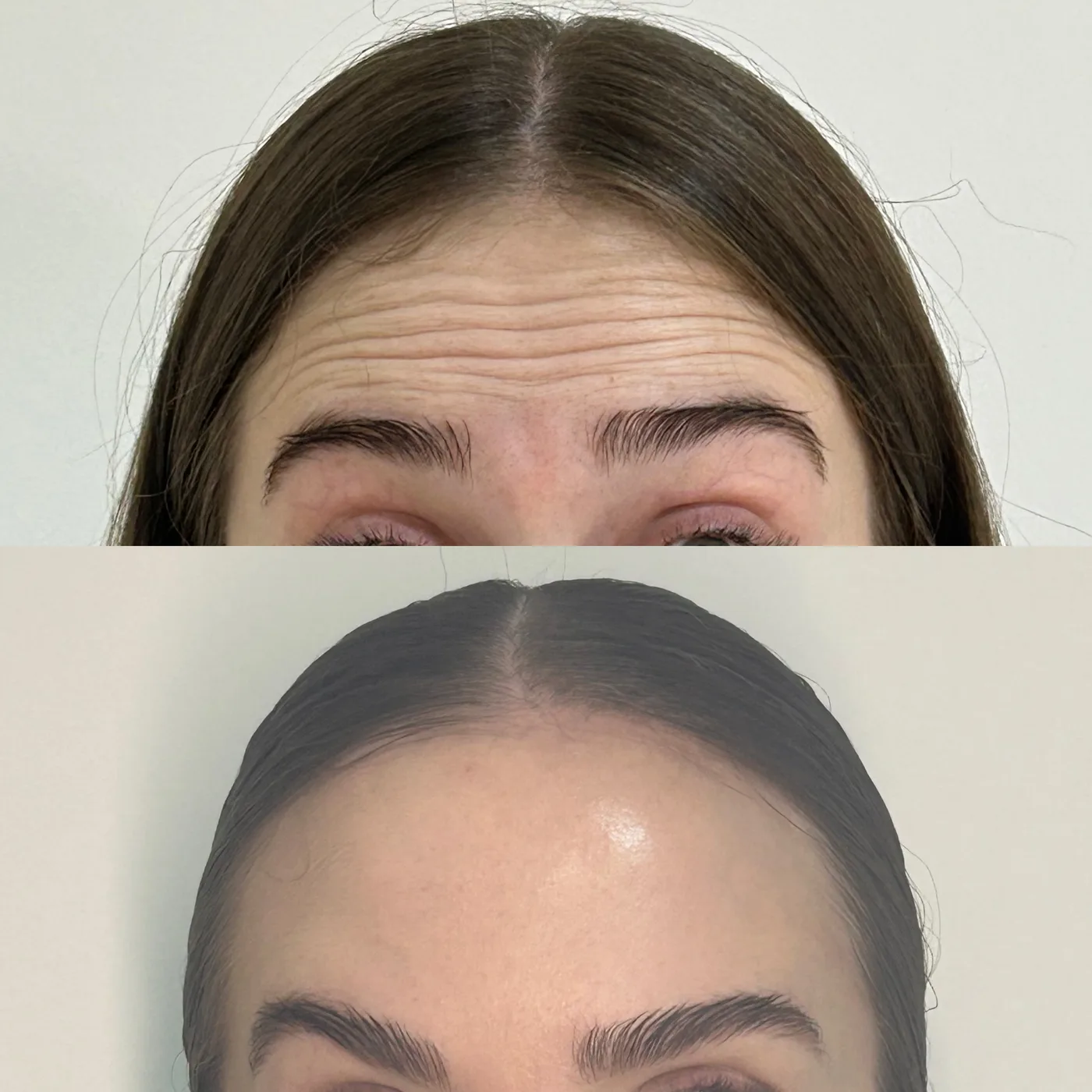 Antes e depois de tratamento antirrugas nas linhas da testa