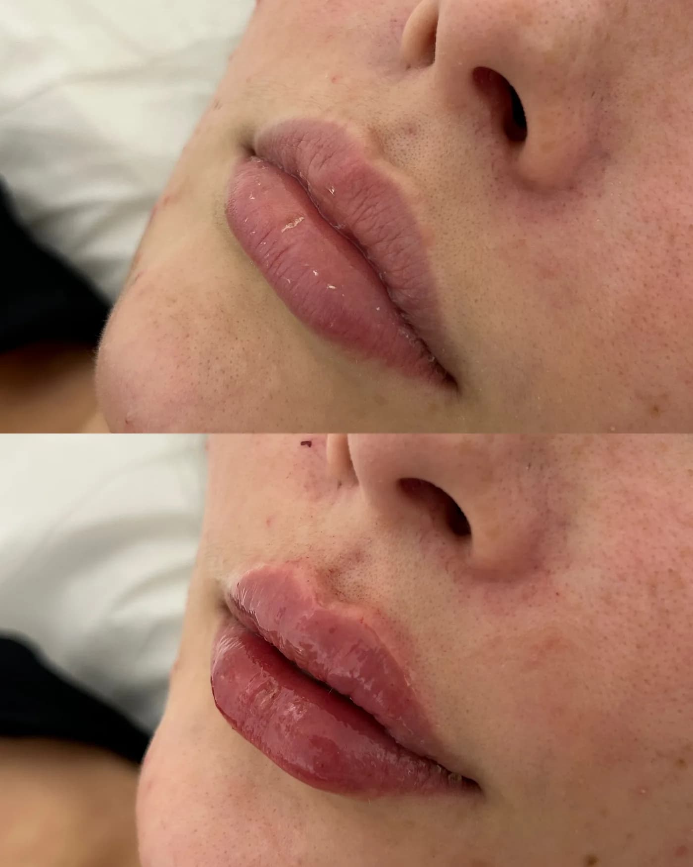 Antes e depois de preenchimento labial