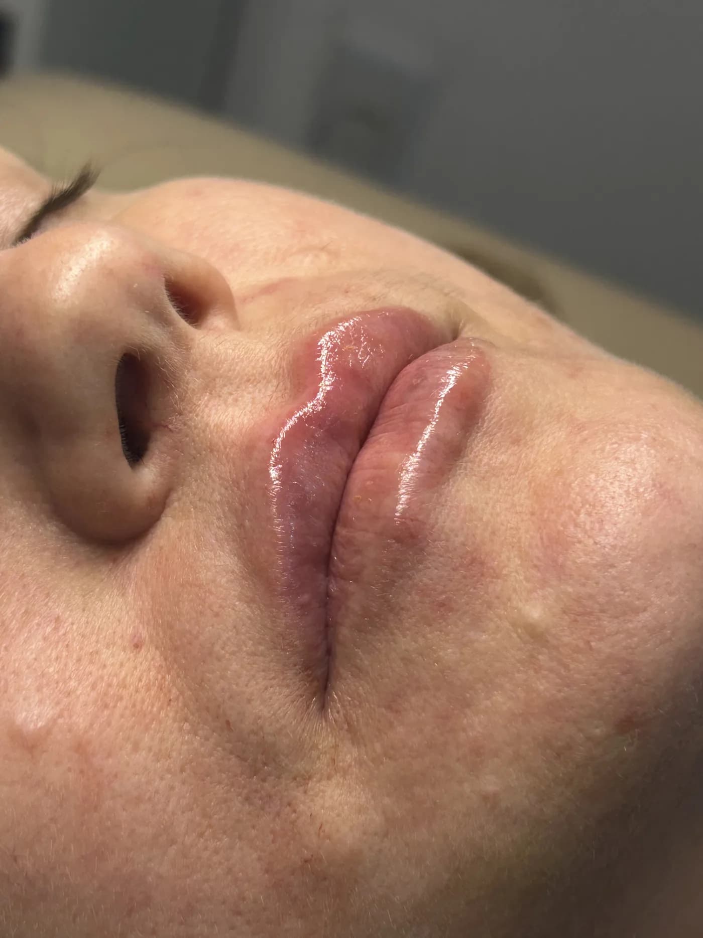 Resultado de preenchimento labial